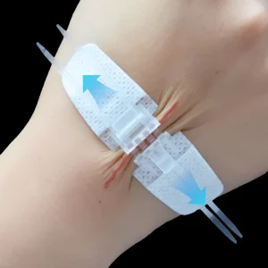2x9cm Medical Wound Closure Device Waterproof PU Film CE Certified Class II for Wound Closure Without Sutures