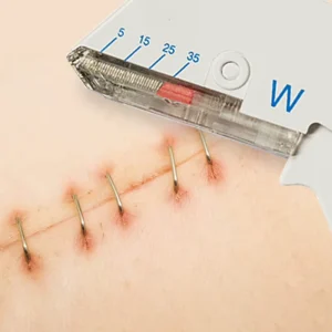 35W Disposable Surgical Skin Stapler Remover Medical Manual Power Source Equipment