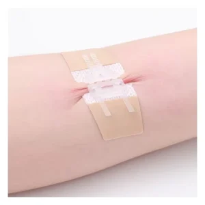 A New Type of Wound Closure Zipper and Wound Closure Device