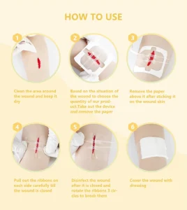 CE Certified Class II Waterproof Transparent Bandage No Pain Stretchable Zipper Wound Closure Device Sterile