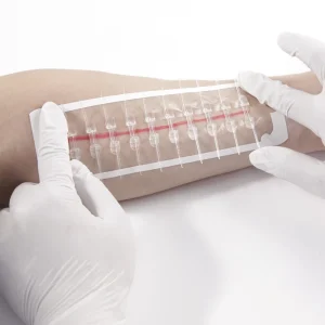 Consumable Medical Device Medical Silk Tape Hydrocolloid Zipstitch Zip Wound Closure Device