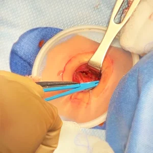 Disposable Alexis Wound Protector Retractor with CE ISO