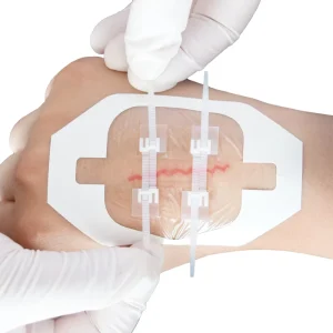 Disposable Medical Zip Tie Skin Wound Closure Device for Emergency Strips Wound Closure Device