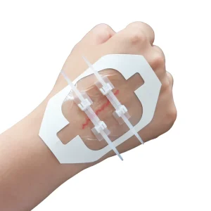 Emergency Self adhesive Wound Closure Device Zip Stitch Wound Closure Device for Skin Wound Suture
