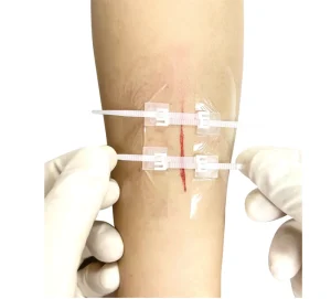 Emergency Wound Closures Surgical Quality Laceration Repair Without Stitches