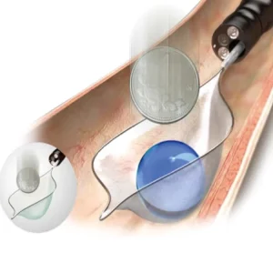 Endoscopic Rotatable Retrieval Net Foreign Body Forceps to Extract Foreign Body Ent Used to Grasp Foreign Matters