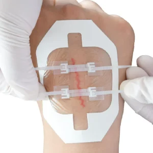 Factory Supply OEM China Medical Dressing Stitch Wound Closure Device Zipper Wound Closure Strip