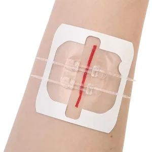 Laceration Trauma Skin Closure Repair Disposable Zip Sutures Emergency Care Wound Closures Device