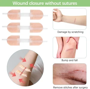 Medical Home Emergency Sterile Wound Closure Device Without Stitches Steri Strips Self adhesive Zipper Suture