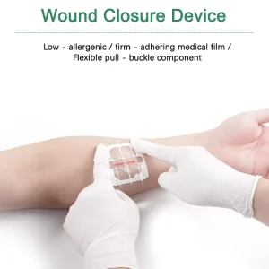 Medical PWT1003 CE Certified Class I Steri Strips Disposable Transparent PU Elastic Wound Closure Device Bacteria