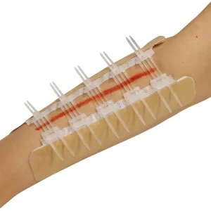 Medical Sterile Skin Color Wound Closure Device First Aid Wound Care Zip Stitch Wound Device
