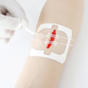 Non invasive Suture Zip PU Wound Closure Device Wound Skin Closure Device Kits Available Manufacturer