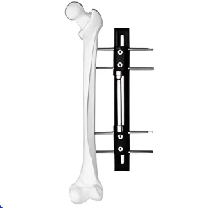 Orthopedic External Fixation System with Wrist Joints External Fixator