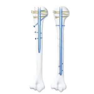 Orthopedic Surgical Humeral Nail for Osteoporotic Bone Fixation