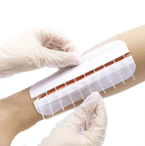 Reusable Adhesive Wound Closure Zipper Noninvasive Skin Repair Device Medical Grade Polyurethane Skin Closure