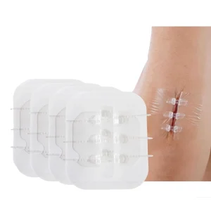 Skin Closure Wound Zipper Tie Medical Dressing Wound Closure Strip