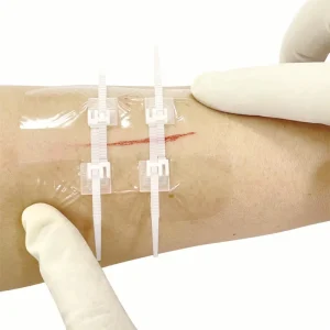 Steri Strip Wound Closure Non Invasive Suture Zip Closure Medical Transparent Zip Stitch Dressing Surgical Wound Skin