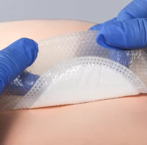 Super Absorbent Dressing With SAP Core Locks Exudate and Bacteria Effectively