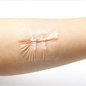 Transparent Waterproof Bacteria Resistant Zipper Band Aid Painless Wound Closure Device Medical Grade Suture Needles Wound Band