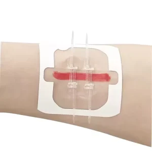Wound Closure Device Wound Device Zip Emergency Wound Closures Band Aid Adhesive Bandages