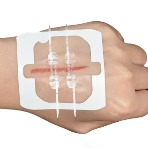Wound Splice Closure Device with Far Infrared Disinfecting CE Certified S M L Sizes for Surgical Use