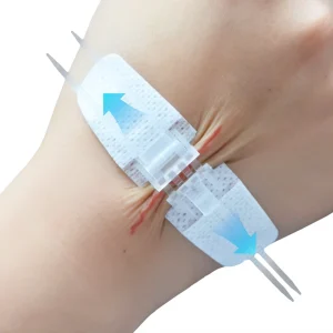 Zip Stitch Sutures Wound Closure Device Skin Closure Strips