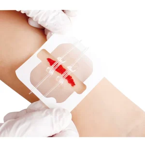 Zip Stitch Wound Closure Device Wound Closure Zipper Wound Closure Strip