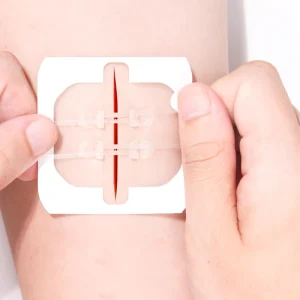 Zip Stitch Wound Closure Wound Closure Device