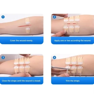 Zip Style Portable Convenient Skin Wound Closure Strap Non Invasive Wound Healing Device CE ISO Certified Class II Medical 2