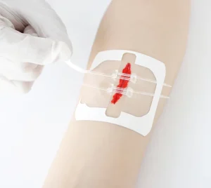 Zip Sutures Butterfly Kit Skin Closure Repair Disposable Zip Sutures Wound Closures Device